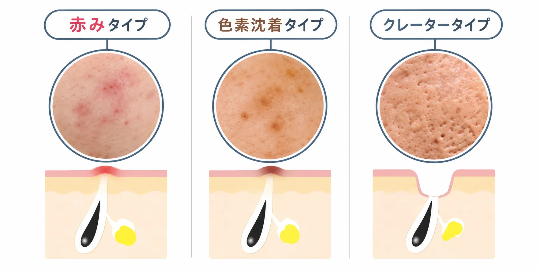 ニキビ跡の3タイプ(赤み・色素沈着・クレーター)の見た目の違い